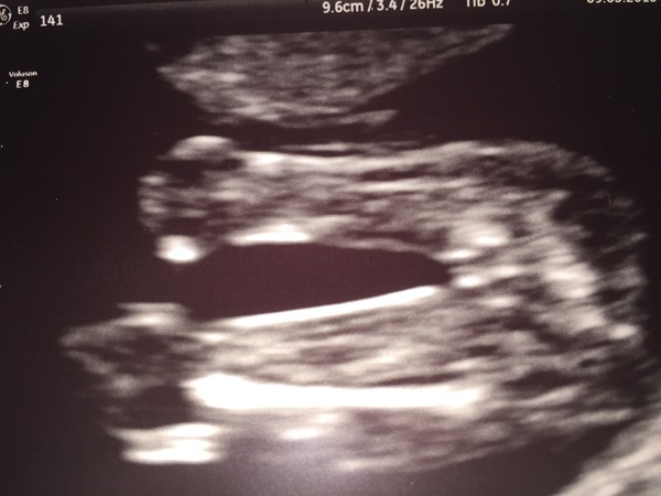 HELP??!! 17 Week Early Gender Scan