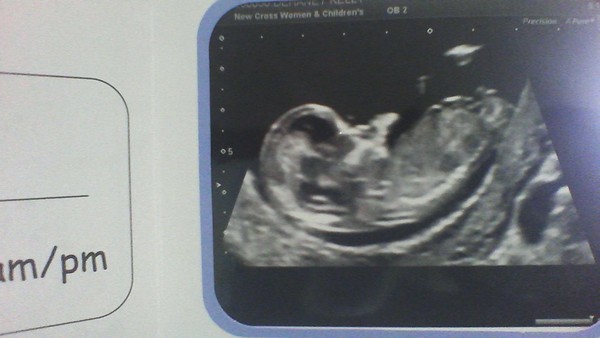 any guesses of the sx of my baby 12 week scan nub theory x