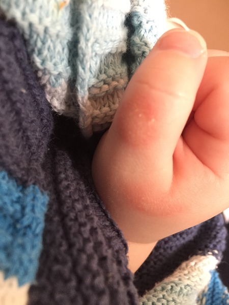 Blisters on DS(9months) thumbs?