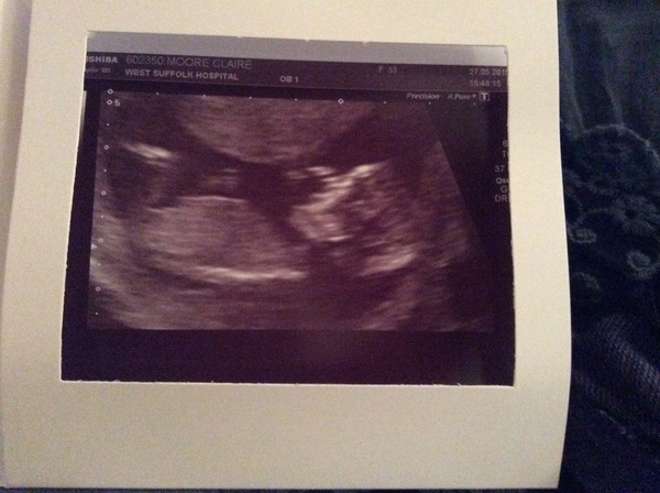 December 2015 #3 - riding out the first trimester!!