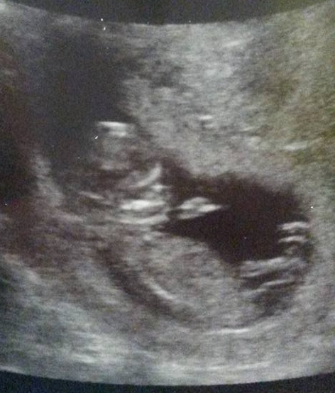 November 2015 mums to be! Here we are! Our bus is decorated with scan pics, our appetites are beginning to heal, and spring is in the air!