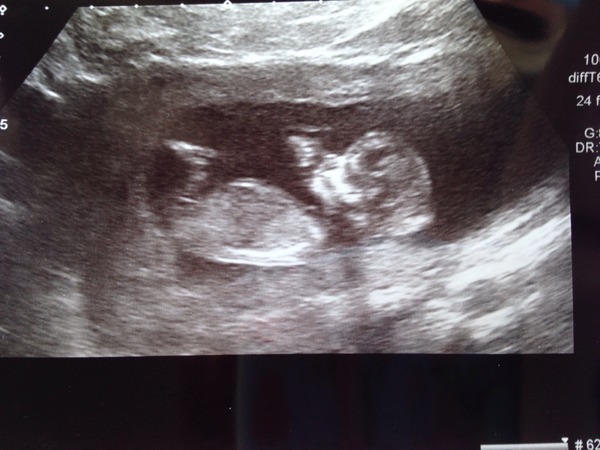 November 2015 mums to be! Here we are! Our bus is decorated with scan pics, our appetites are beginning to heal, and spring is in the air!