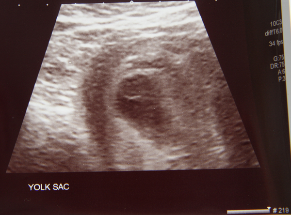 We might be over 40 but we are young at heart, taking our supplements, shagging on time and waiting for the precious BFP!Over 40's TTC, join us here...