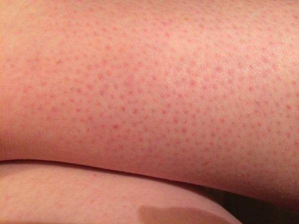 Phillips Lumea or similar - laser hair removal