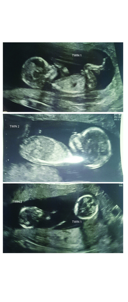 November 2015 mums to be! Here we are! Our bus is decorated with scan pics, our appetites are beginning to heal, and spring is in the air!