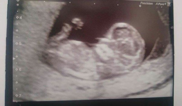 12wk scan boy or girl? &#55357&#56842