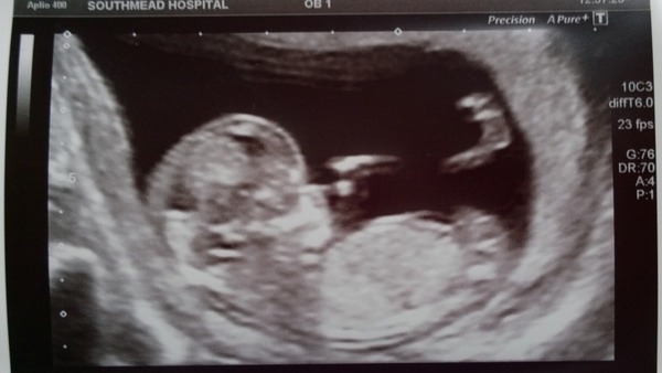 December 2015 #3 - riding out the first trimester!!