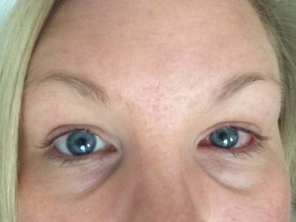 Is this conjunctivitis? Photo attached