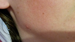 Hormonal acne misery.... Please help!