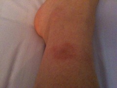 Bullseye rash (Lymes?) how clued up are GPs/will they take it seriously