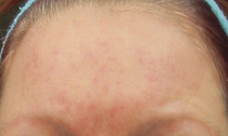 Another moisturiser and/or sunscreen has given me a face-full of spots! Arrrgh. *pics*