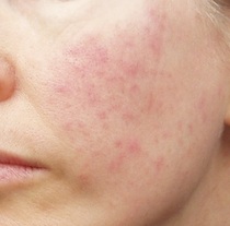 Another moisturiser and/or sunscreen has given me a face-full of spots! Arrrgh. *pics*
