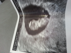 am i 10 weeks or 14 just need something clarified ?