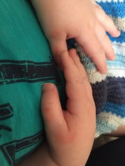 Blisters on DS(9months) thumbs?