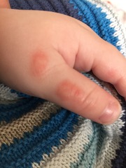Blisters on DS(9months) thumbs?