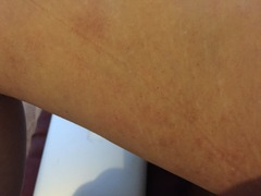 Fungal or eczema? Pics