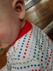 Help! Rash - what is this