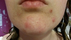 Hormonal acne misery.... Please help!