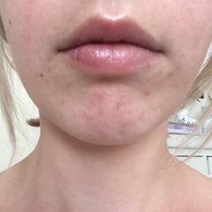 Help sort my skin (pics included)