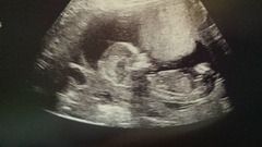 best shit place grass #3. Still pregnant and scans ahoy. End of the year can't come soon enough!