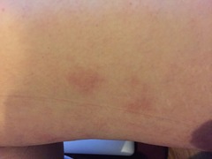 Fungal or eczema? Pics