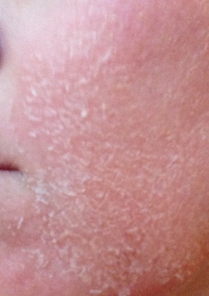 I'm having my first IPL tomorrow for sun-spots!