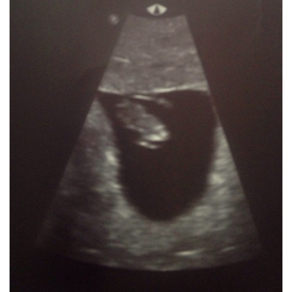 Jan 2016 #4 - heading for the end of the 1st trimester with dating scans and wacky dreams