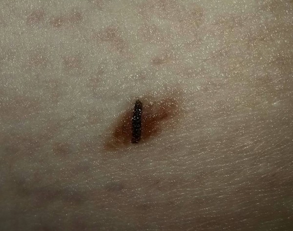 to go to the GP about this mole? (Pic warning). DM seems to think so...