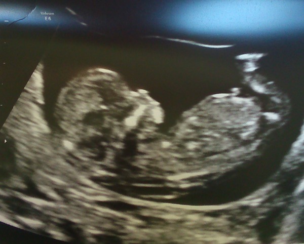 Jan 2016 #5 - Scanxiety, sickness and sweet relief as we approach the second trimester!