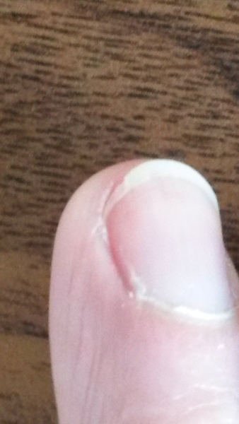 Why does my nail do this? Photo attached