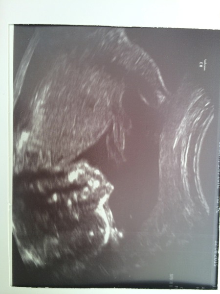 boy or girl- 20 week scan