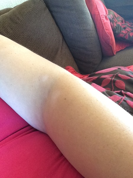 Anyone here have experience with Vitiligo