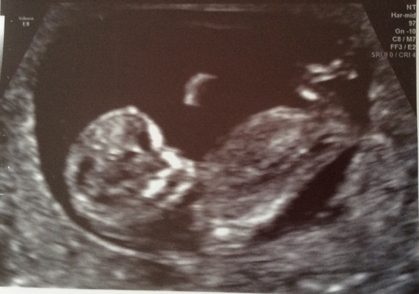 Jan 2016 #5 - Scanxiety, sickness and sweet relief as we approach the second trimester!