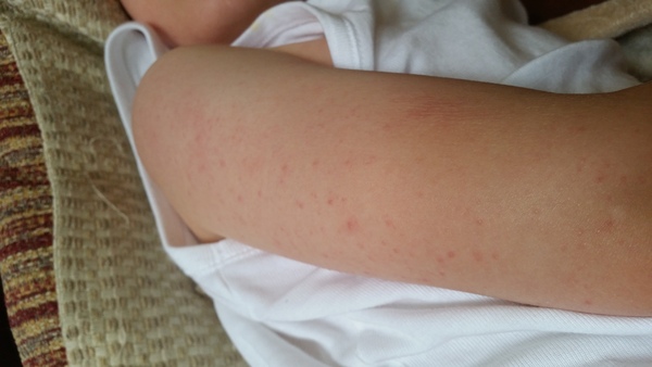 Weird rash,poorly DS - help me diagnose please.