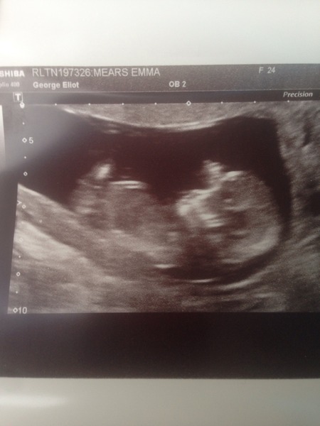 12+4 scan picture any ideas boy or girl??