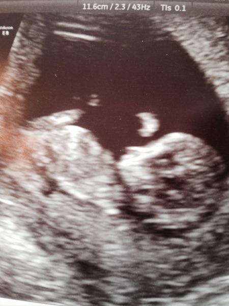 Jan 2016 #4 - heading for the end of the 1st trimester with dating scans and wacky dreams