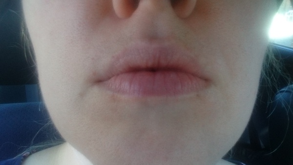 What is this odd discolouration around my lips?!