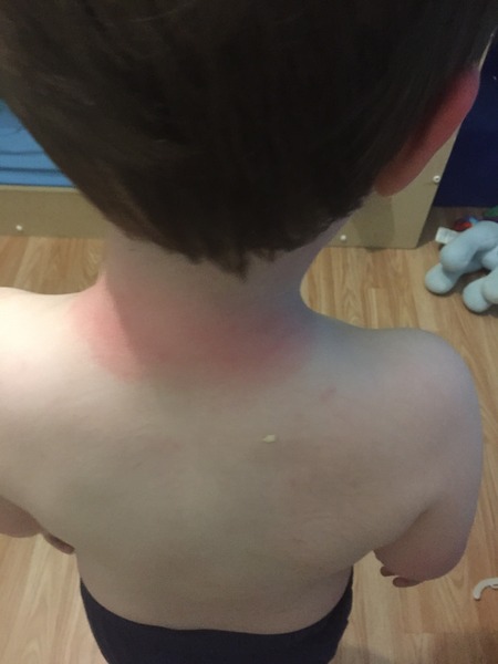 DS came home from nursery sunburnt to f**k. AIBU?