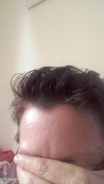 thinking of having a one off botox jab in forehead