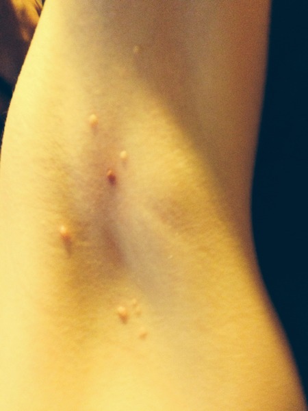 moluscum contagiosum?( pics included)
