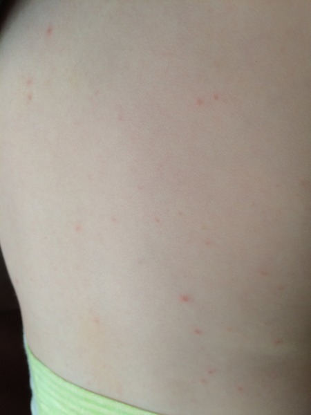 Is this chickenpox???