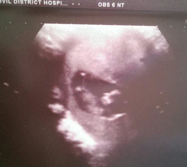 Jan 2016 #4 - heading for the end of the 1st trimester with dating scans and wacky dreams