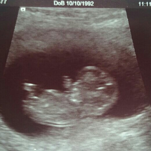 Jan 2016 #5 - Scanxiety, sickness and sweet relief as we approach the second trimester!