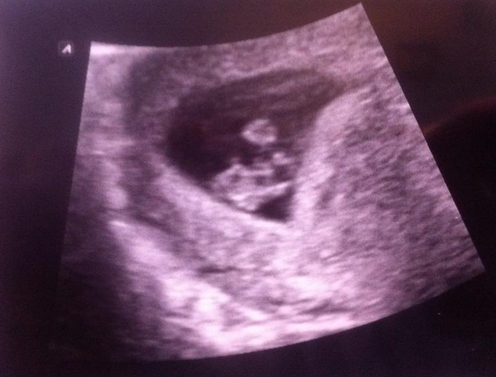 Jan 2016 #4 - heading for the end of the 1st trimester with dating scans and wacky dreams