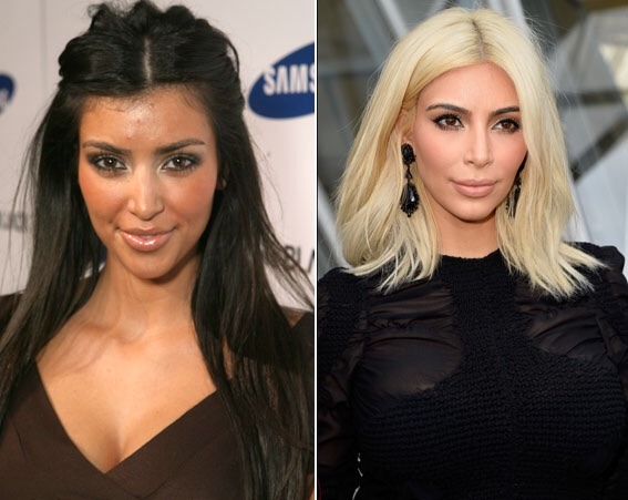 To think that Kris Jenner is wrong to let a 17 year old get extensive plastic surgery.