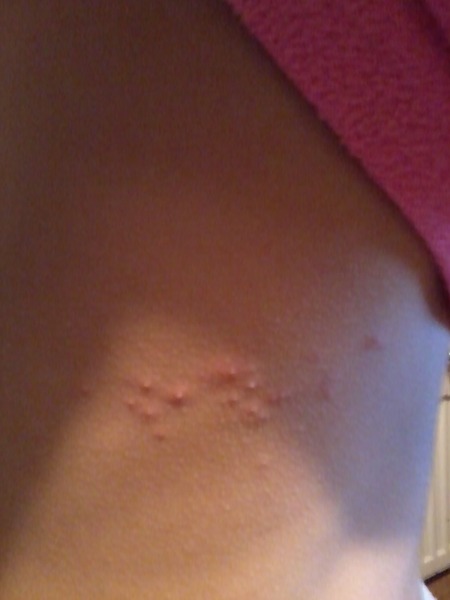 Not chickenpox so what could it be?