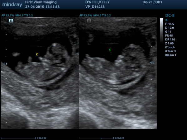Jan 2016 #5 - Scanxiety, sickness and sweet relief as we approach the second trimester!