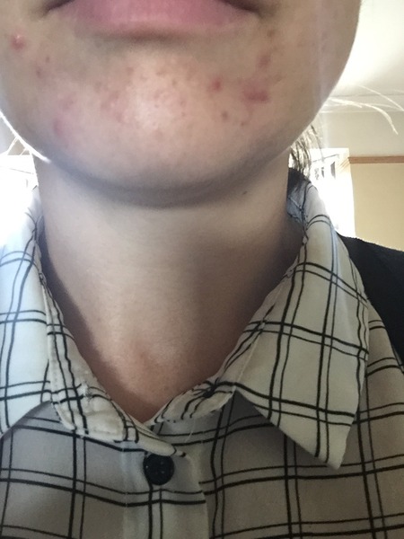 Back on antibiotics for my acne.....I'm 36 and fed up