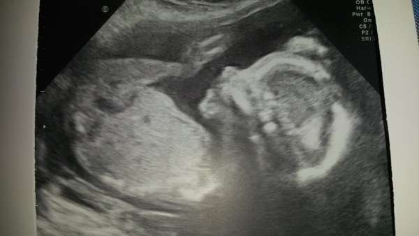 best shit place grass #3. Still pregnant and scans ahoy. End of the year can't come soon enough!