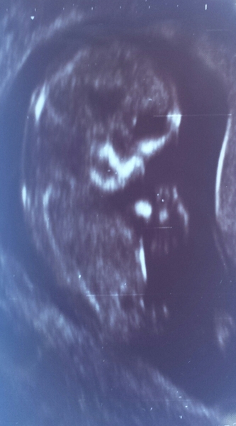 Jan 2016 #5 - Scanxiety, sickness and sweet relief as we approach the second trimester!